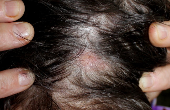 Facing Lichen Planopilaris: Coping with Hair Loss and Finding Comfort in Wigs