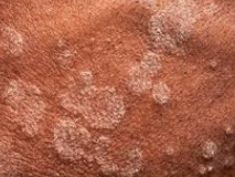 Tinea Capitis: What You Should Know About This Sneaky Scalp Infection