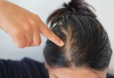 Hypothyroidism, Hair Loss & Wigs: When Your Thyroid Messes With Your Hair