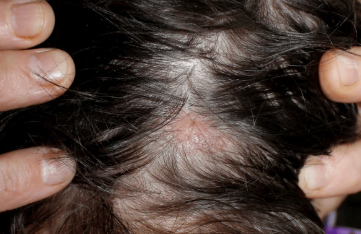 Lichen Planopilaris and Hair Loss: How Wigs Can Help You Regain Confidence