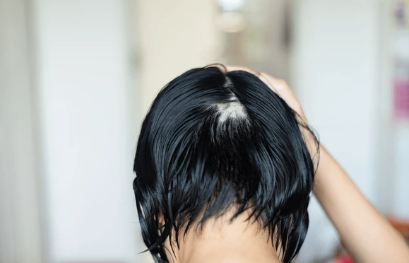 Coping with Alopecia Areata: Why Wigs Can Make a Difference