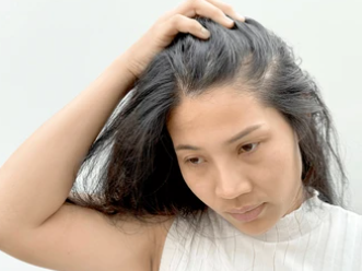 Coping with Lupus Hair Loss: Why Wigs Are More Than Just a Cover-Up
