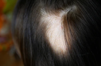 Why Alopecia Areata Happens and Options for Coping