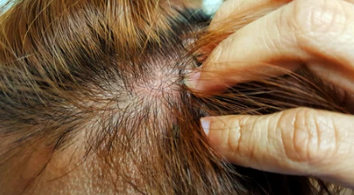 Understanding Tinea Capitis: Causes, Treatment, and How Wigs Can Help During Recovery