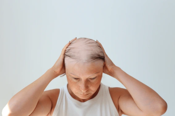 Understanding the Types of Alopecia