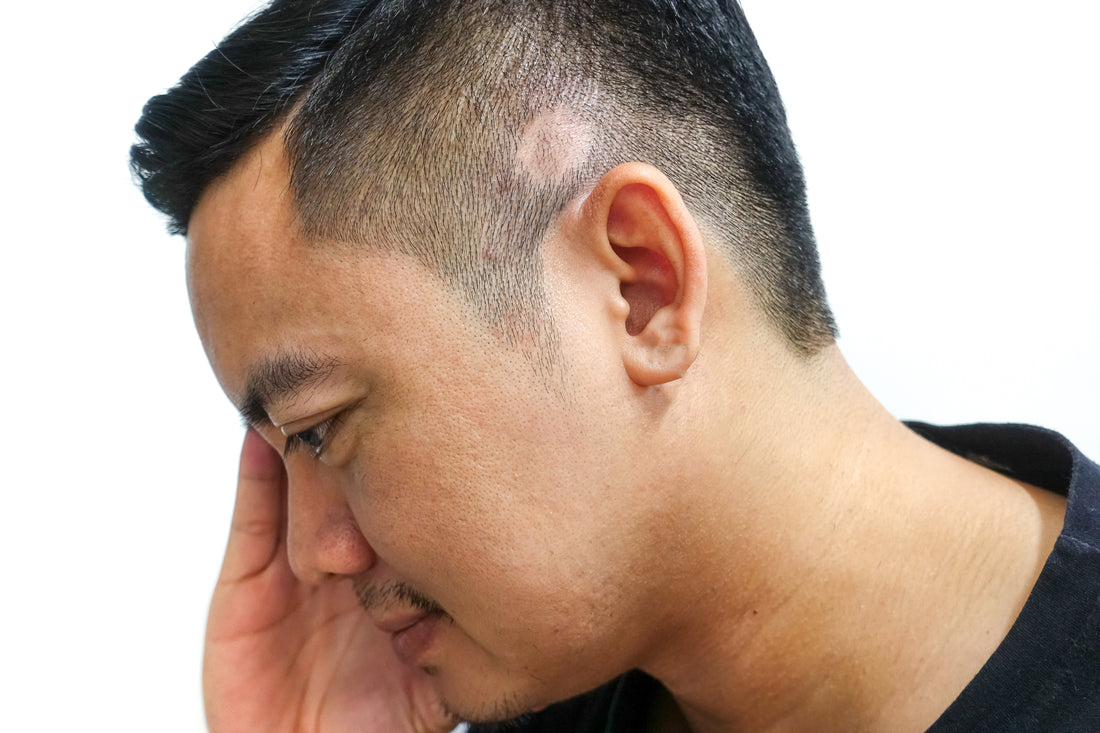 Wigs for Cicatricial Alopecia: A Confidence Boost