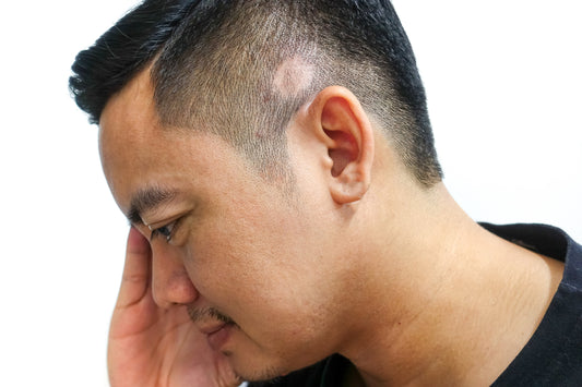 Wigs for Cicatricial Alopecia: A Confidence Boost