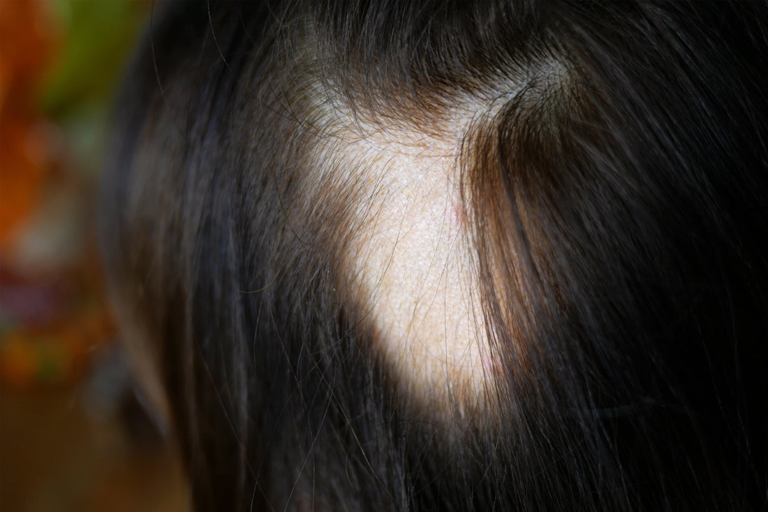 Managing Lichen Planopilaris Hair Loss with Confidence: Why Wigs Work