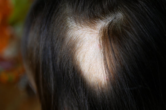 Managing Lichen Planopilaris Hair Loss with Confidence: Why Wigs Work