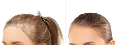 Scalp Infections, Hair Loss, and How Wigs Can Help You Feel Like Yourself Again