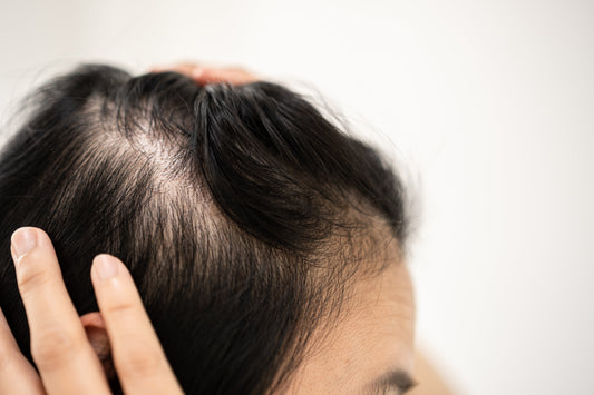Can Wigs Help With Traction Alopecia? Here’s What You Need to Know